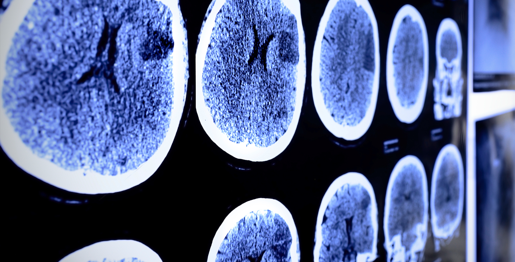 Traumatic Brain Injury Claims in California 